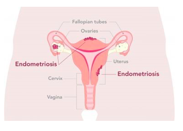 Endometriosis