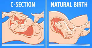 Vaginal Delivery vs C-Section